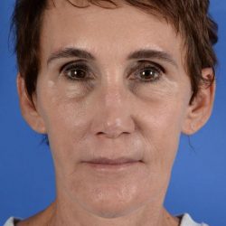 Face Lift - Neck Lift Before & After Patient #2280