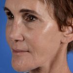Facelift Neck Lift Before & After Patient #2280