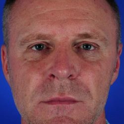 Primary Rhinoplasty Before & After Patient #1715