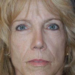 Revision Rhinoplasty Before & After Patient #1872