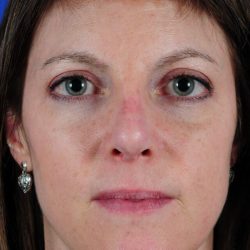 Revision Rhinoplasty Before & After Patient #1873