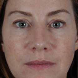 Revision Rhinoplasty Before & After Patient #1921