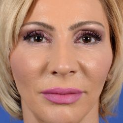 Revision Rhinoplasty Before & After Patient #1923