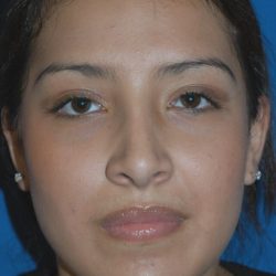 Ethnic Rhinoplasty Before & After Patient #1974