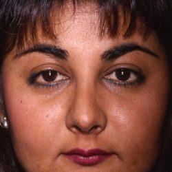 Ethnic Rhinoplasty Before & After Patient #1975