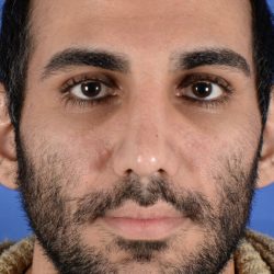 Ethnic Rhinoplasty Before & After Patient #1976
