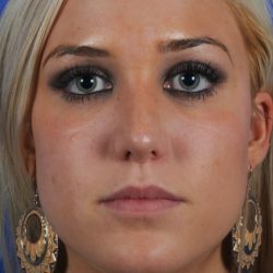 Primary Rhinoplasty Before & After Patient #1655