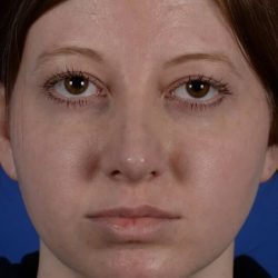 Revision Rhinoplasty Before & After Patient #1922