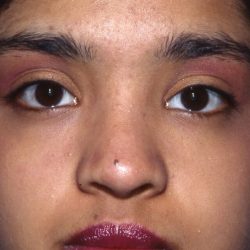Ethnic Rhinoplasty Before & After Patient #2037