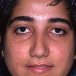 Ethnic Rhinoplasty Before & After Patient #2038