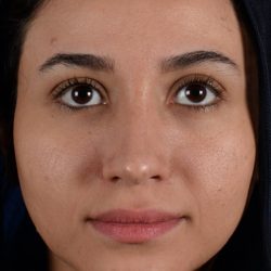 Ethnic Rhinoplasty Before & After Patient #2039