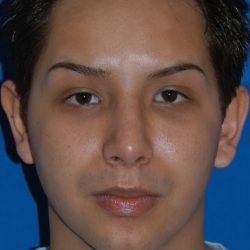 Ethnic Rhinoplasty Before & After Patient #2042
