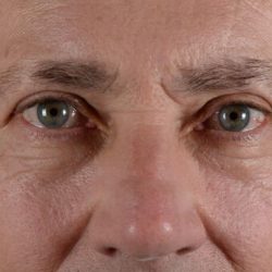 Blepharoplasty Before & After Patient #2165