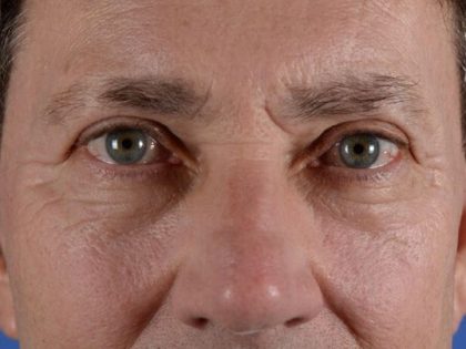 Blepharoplasty Before & After Patient #2165