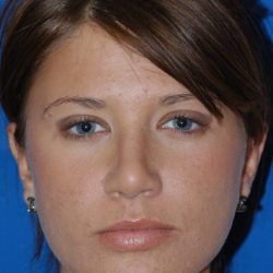 Primary Rhinoplasty Before & After Patient #1652
