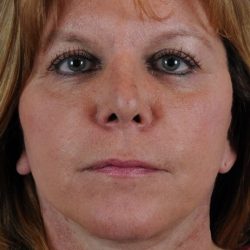 Face Lift - Neck Lift Before & After Patient #2236