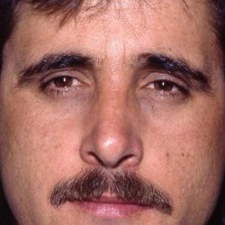 Revision Rhinoplasty Before & After Patient #1822