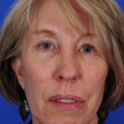 Face Lift - Neck Lift Before & After Patient #2274
