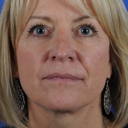 Face Lift - Neck Lift Before & After Patient #2275