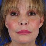 Facelift Neck Lift Before & After Patient #2276