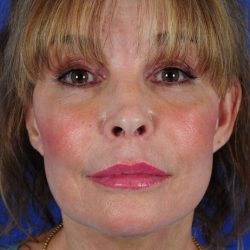 Facial Fat Transfer Before & After Patient #2324