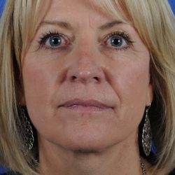 Facial Fat Transfer Before & After Patient #2326