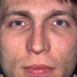 Revision Rhinoplasty Before & After Patient #1823