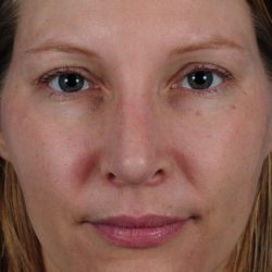 Revision Rhinoplasty Before & After Patient #1825