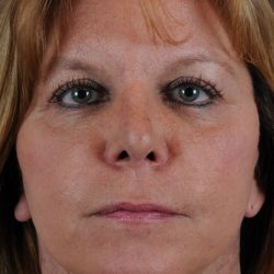 Revision Rhinoplasty Before & After Patient #1871