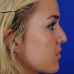Primary Rhinoplasty Before & After Patient #1655