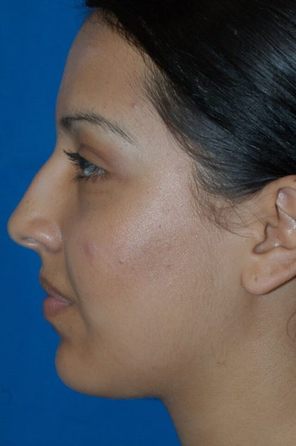 Ethnic Rhinoplasty Before & After Patient #1974