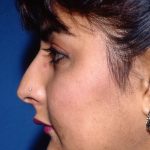 Ethnic Rhinoplasty Before & After Patient #1975