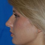 Primary Rhinoplasty Before & After Patient #1652