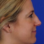 Primary Rhinoplasty Before & After Patient #1653