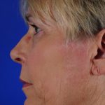 Facelift Neck Lift Before & After Patient #2237