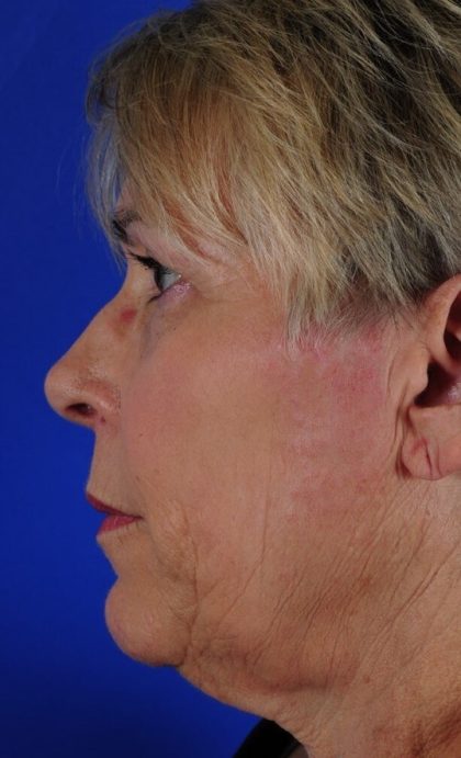 Facelift Neck Lift Before & After Patient #2237