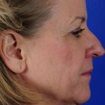 Facelift Neck Lift Before & After Patient #2275