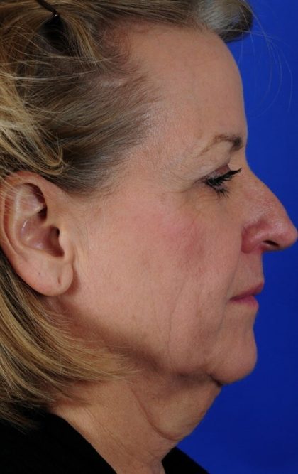 Facelift Neck Lift Before & After Patient #2275