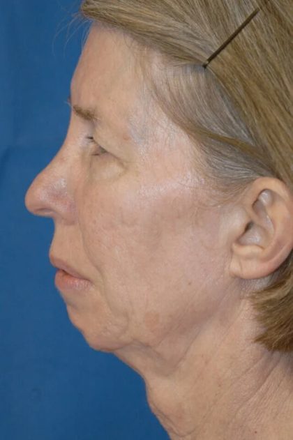 Facial Implants Before & After Patient #2113