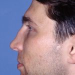 Revision Rhinoplasty Before & After Patient #1823