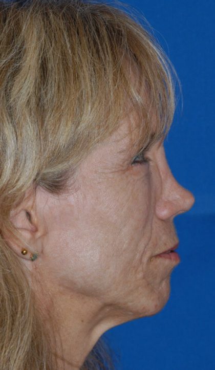 Revision Rhinoplasty Before & After Patient #1872
