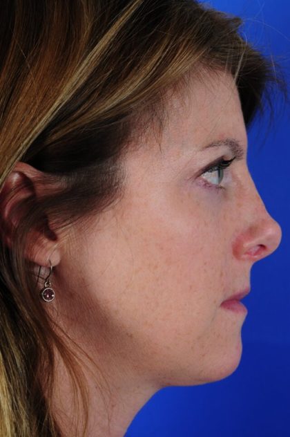 Revision Rhinoplasty Before & After Patient #1873