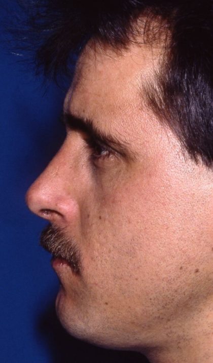 Revision Rhinoplasty Before & After Patient #1822