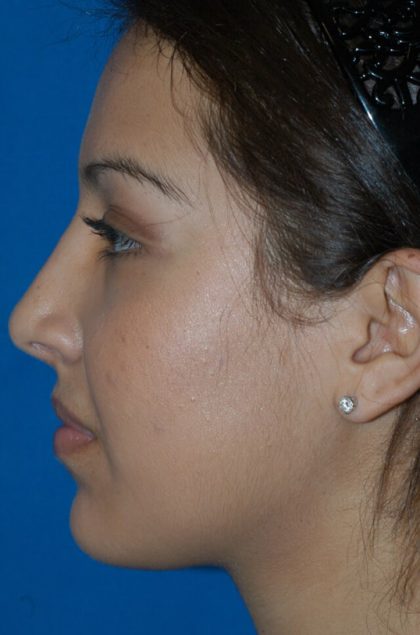 Ethnic Rhinoplasty Before & After Patient #1974