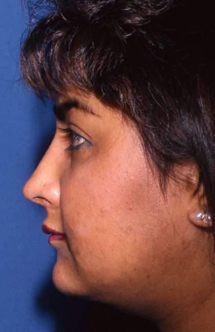 Ethnic Rhinoplasty Before & After Patient #1975