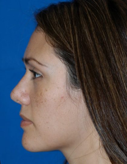 Ethnic Rhinoplasty Before & After Patient #1977