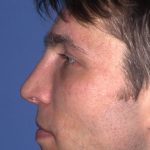 Revision Rhinoplasty Before & After Patient #1823