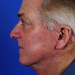 Facelift Neck Lift Before & After Patient #2235