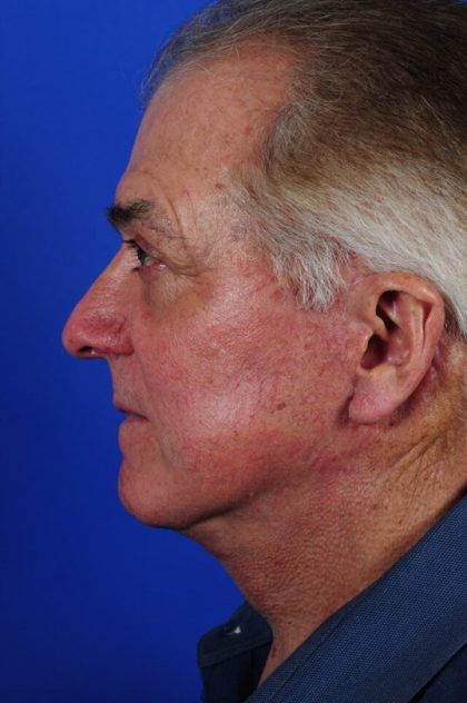 Facelift Neck Lift Before & After Patient #2235