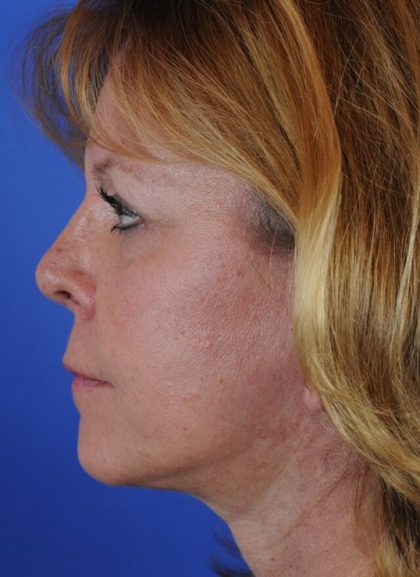 Facelift Neck Lift Before & After Patient #2236
